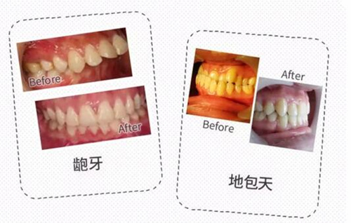 宁波徐茂口腔医院牙齿矫正日记