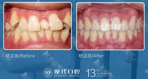 宁波现代口腔医院牙齿矫正对比