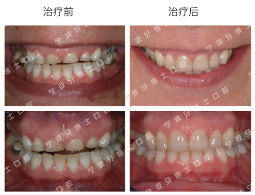 宁波牙博士口腔医院牙齿矫正案例