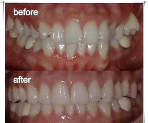 深圳诺德齿科口腔连锁牙齿矫正案例对比