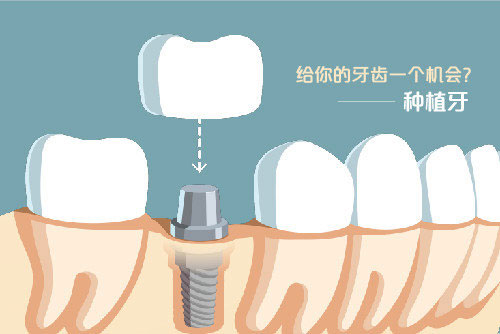种植牙动画示意图