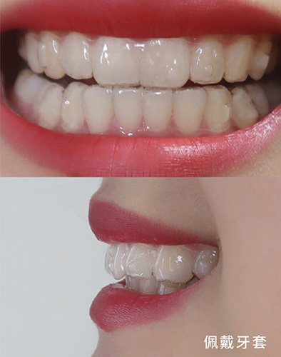 隐形牙套1~12月变化图图片