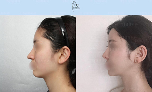 韩国TJ整形外科鼻部整形前后对比照