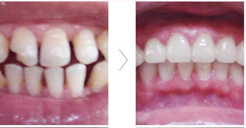 嘉兴曙光整形医院全瓷嵌体矫正牙齿畸形手术<span style=