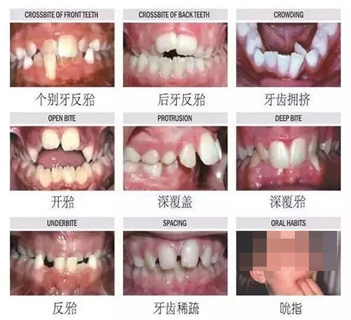 牙齿错合的各种类型