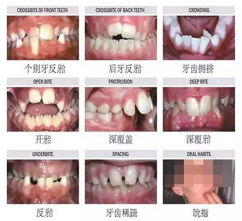 牙齒錯合的各種類型