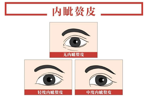 內(nèi)眥贅皮手術示意圖