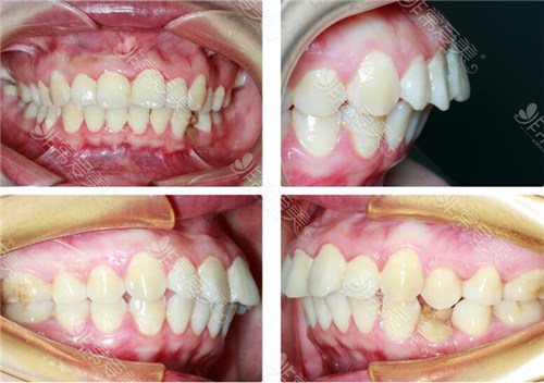 成都极光口腔骨性牙性龅牙矫正术前图
