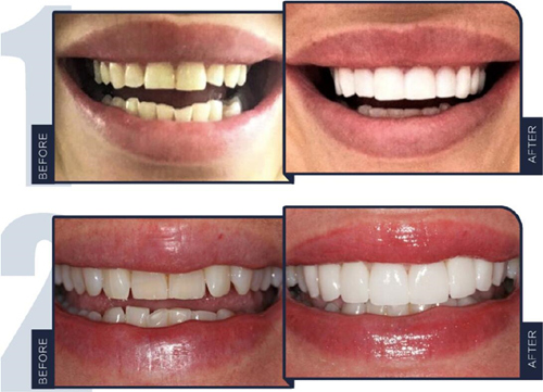 广州牙贴面真实案例对比图