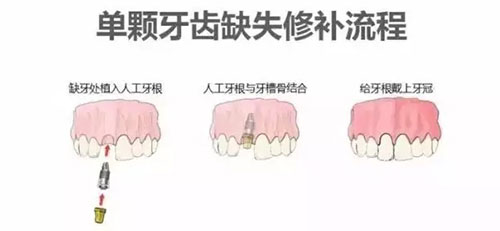 单颗牙种植过程图