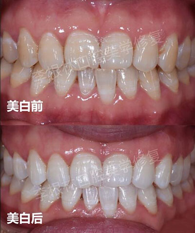 李根林牙齿修复前后对比