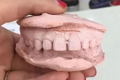 深圳弘和医院的牙齿矫正牙模