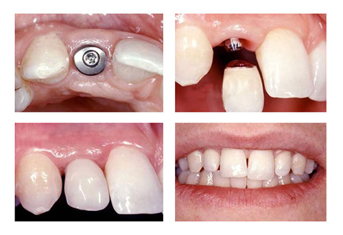 种植牙过程示范对比照片