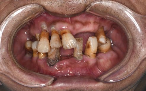 鼎植口腔牙齿种植案例（前）