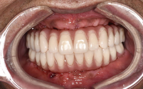 鼎植口腔牙齿种植案例（后）