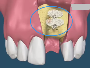 种植牙补骨
