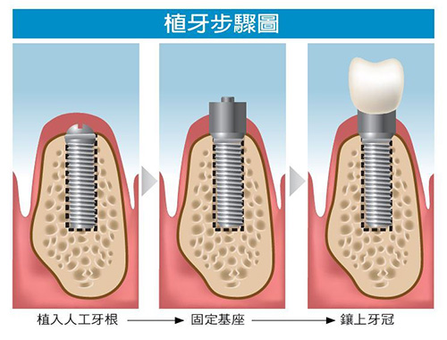 种植牙步骤图