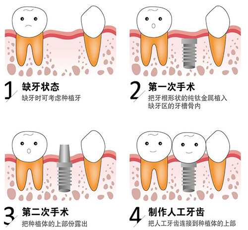 种植牙过程展示