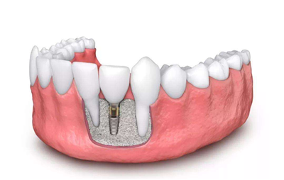 种植牙示意图