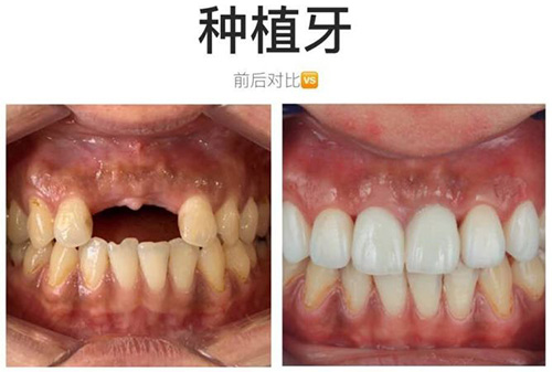 珠海种植牙哪家医院比较好 整理口腔医院种牙价格表公开