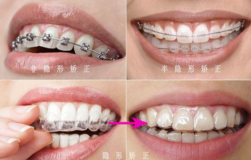 在深圳做牙齿矫正好的医院推荐隐形矫正牙套价目表公布