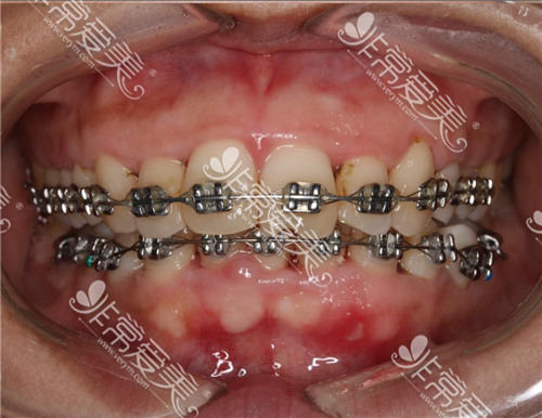雅度口腔金属自锁矫正术后三个月疗效图