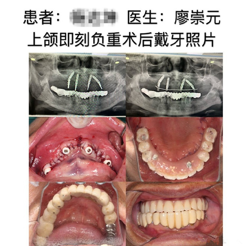 廖崇元即刻负重牙齿种植案例