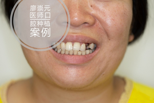 广州牙齿即刻种植