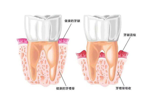 健康的牙槽骨和牙槽骨退缩对比