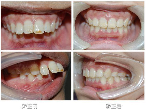 温州牙齿矫正牙套价目表 收费标准多少钱马上告诉你