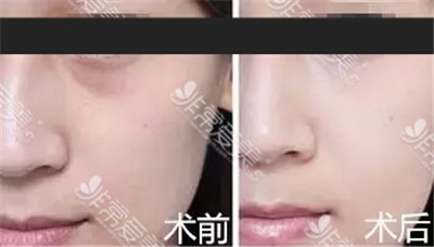 江南k-beauty整形医院面中提升三件套效果 江南k-beauty整形医院面中提升三件套效果