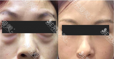 江南k-beauty整形医院面中提升三件套对比 江南k-beauty整形医院面中提升三件套对比