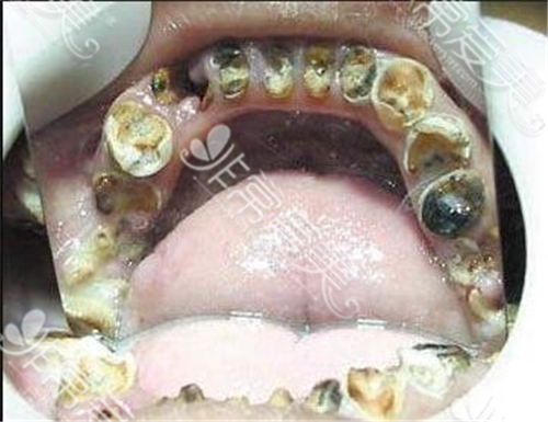 牙龈萎缩牙周病可以种植牙吗