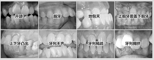 需要進(jìn)行牙齒矯正的適應(yīng)癥