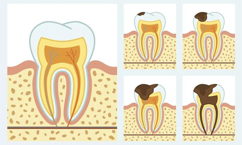 牙齿龋坏不同程度