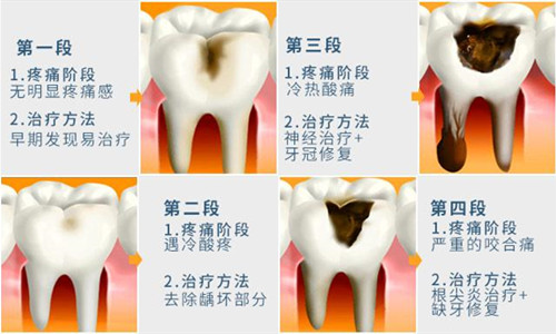 龋齿不同程度的图片图片