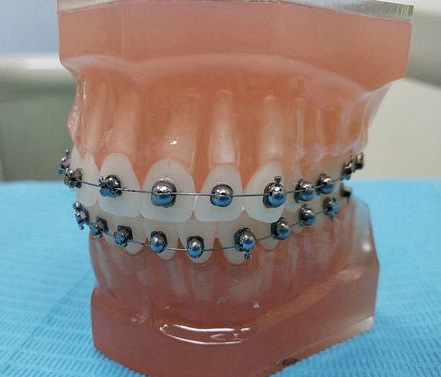 有人做过球形托槽牙齿矫正吗?这个产品咋样?坐标赣州