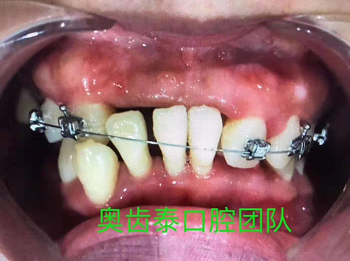 奥齿泰牙齿矫正案例对比图 前