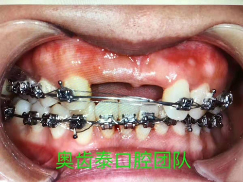 奥齿泰牙齿矫正案例对比图 后