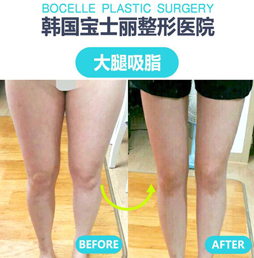 韩国宝士丽整形吸脂瘦大腿前后对比案例 30天改变腿型不是梦想 韩国宝士丽整形外科 非常爱美网