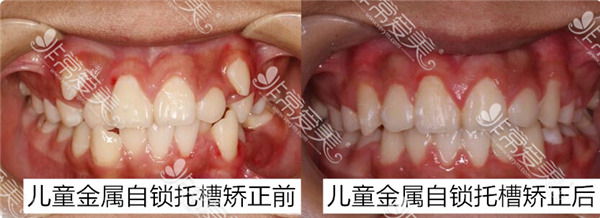 昆明美奥口腔医院收费高吗?近期牙齿矫正优惠活动方案是啥?