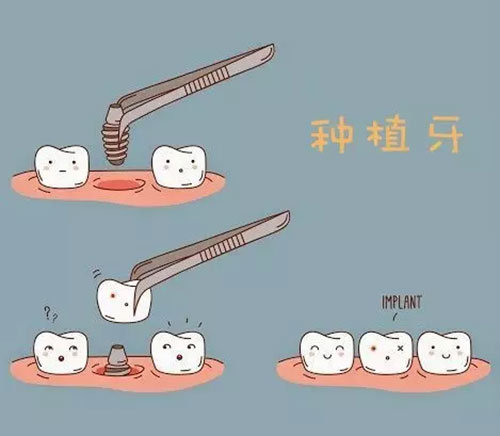 种植牙的过程