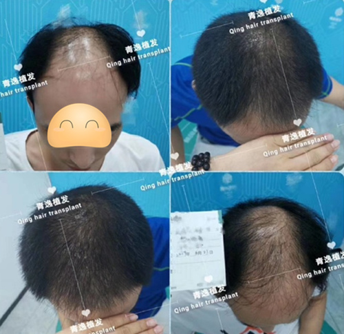 广州青逸植发医疗美容医院头顶加密植发案例