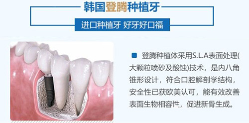 韩国登腾种植牙质量怎么样 是不是使用寿命短才这么便宜