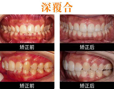 石家庄中诺口腔深覆合日记对比