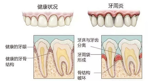 健康牙齿和牙周炎区别
