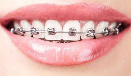 牙齿矫正托槽对牙齿及<span style=