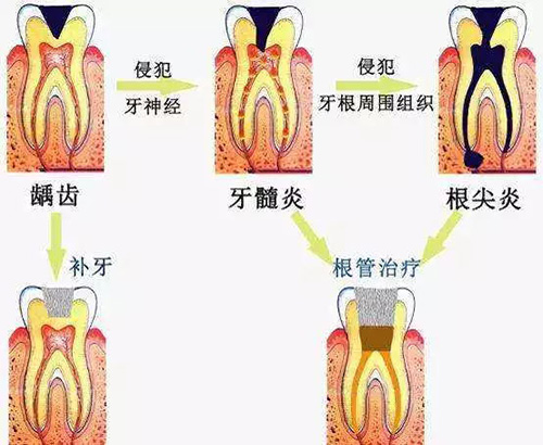 牙齿矫正龋齿及牙髓炎治疗