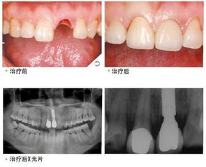 广州越秀区口腔医院哪家好些?越秀圣贝口腔靠谱吗?附整牙价