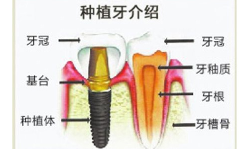 种植牙示意图